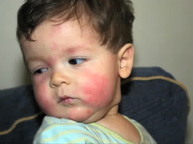 Food Allergy Rash Baby, Found On Face